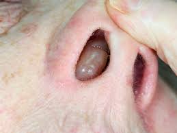 Nasal Polyps